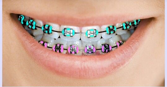 Best Color For Braces